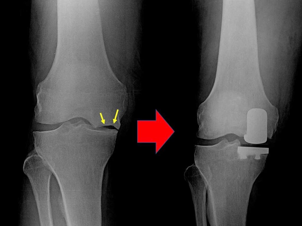Broken Knee to Partial Knee Replacement