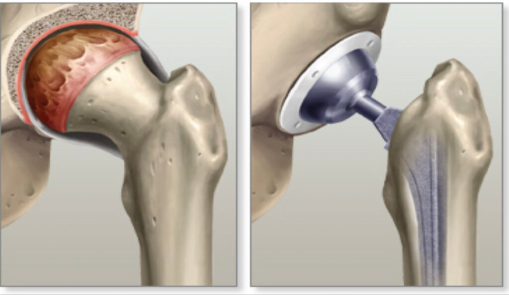 Hip Replacement Surgery