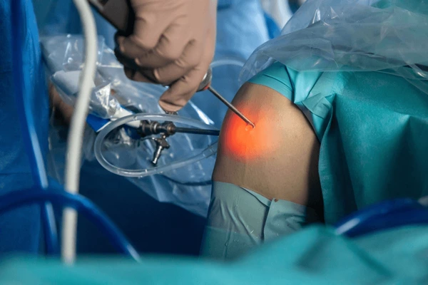 Knee Arthroscopy